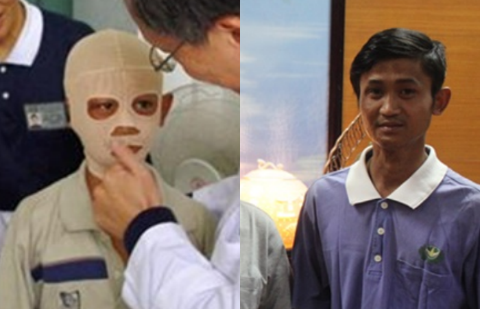 為了搶救小生命,密威喬被送到仰光醫院動手術,並由慈濟承擔所有的醫療費用,從整容到換皮等等的治療,經過一段冗長的時間,才讓密威喬能夠痊癒出院。要出院時,他向上人發願,說如果將來上學,一定不辜負大家的期許。(慈濟志工提供)